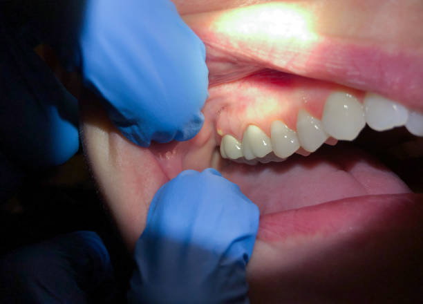 Best Broken or Cracked Tooth Emergency Dentist in Gold Bar, WA